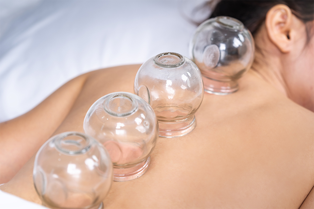 Cupping featured Cupping